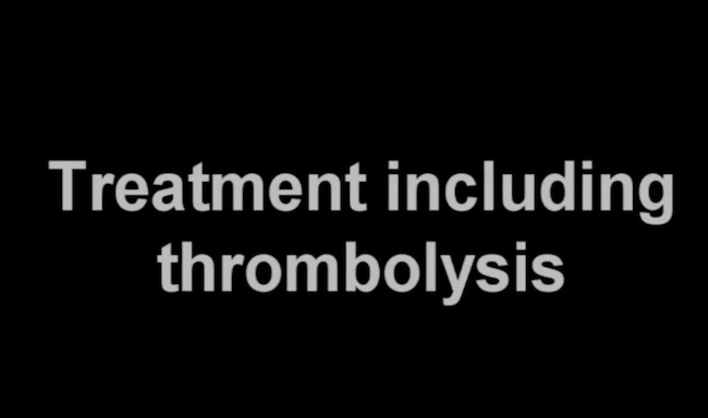 Treatment Including Thrombolysis